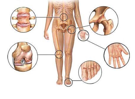 Артропатия поражает различные суставы.